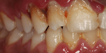 ThS.BS Nguyễn Quang Tiến – CEO Bệnh viện Răng Hàm Mặt Sài Gòn hướng dẫn cách xử lý khi lợi bị thâm đen